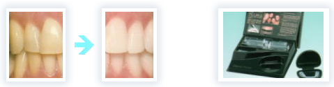 ホームホワイトニングの例
